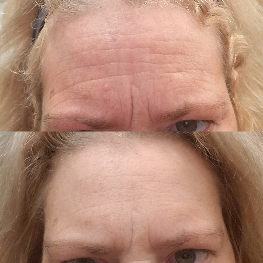 How to Get Rid of Forehead Wrinkles & Frown Lines (Without Needles!)