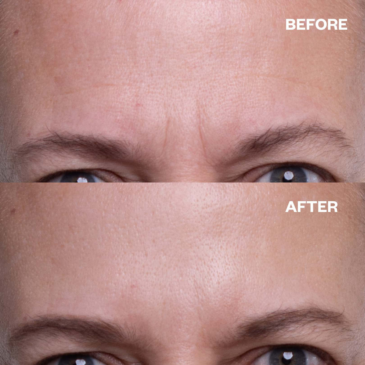 Brow Frown & Bunny Lines Wrinkle Patch | Trial Patch