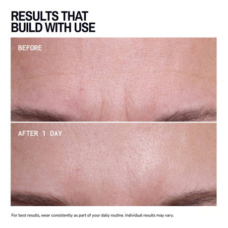 Brow Frown & Bunny Lines Wrinkle Patches