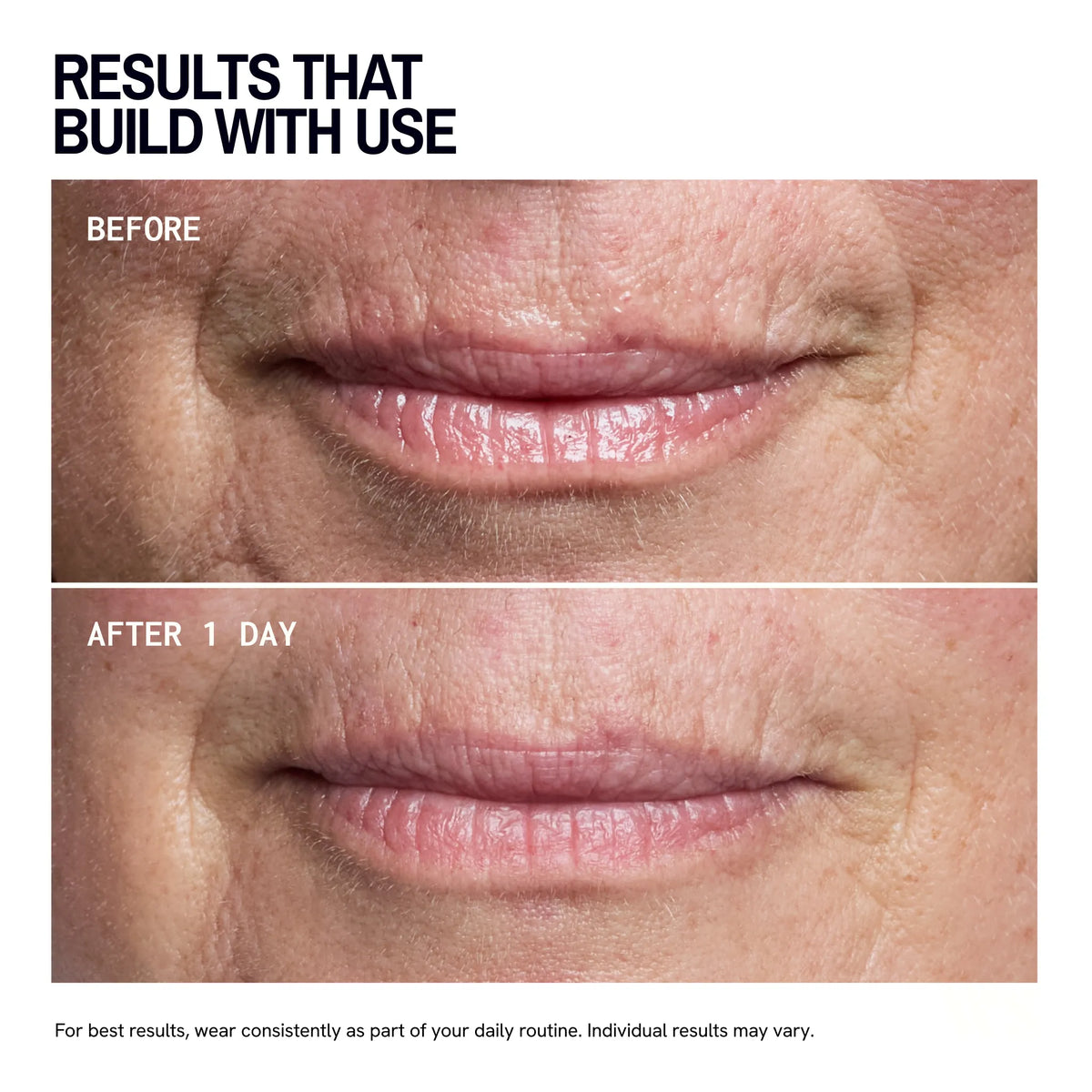 Mouth & Lip Wrinkle | Trial Patch