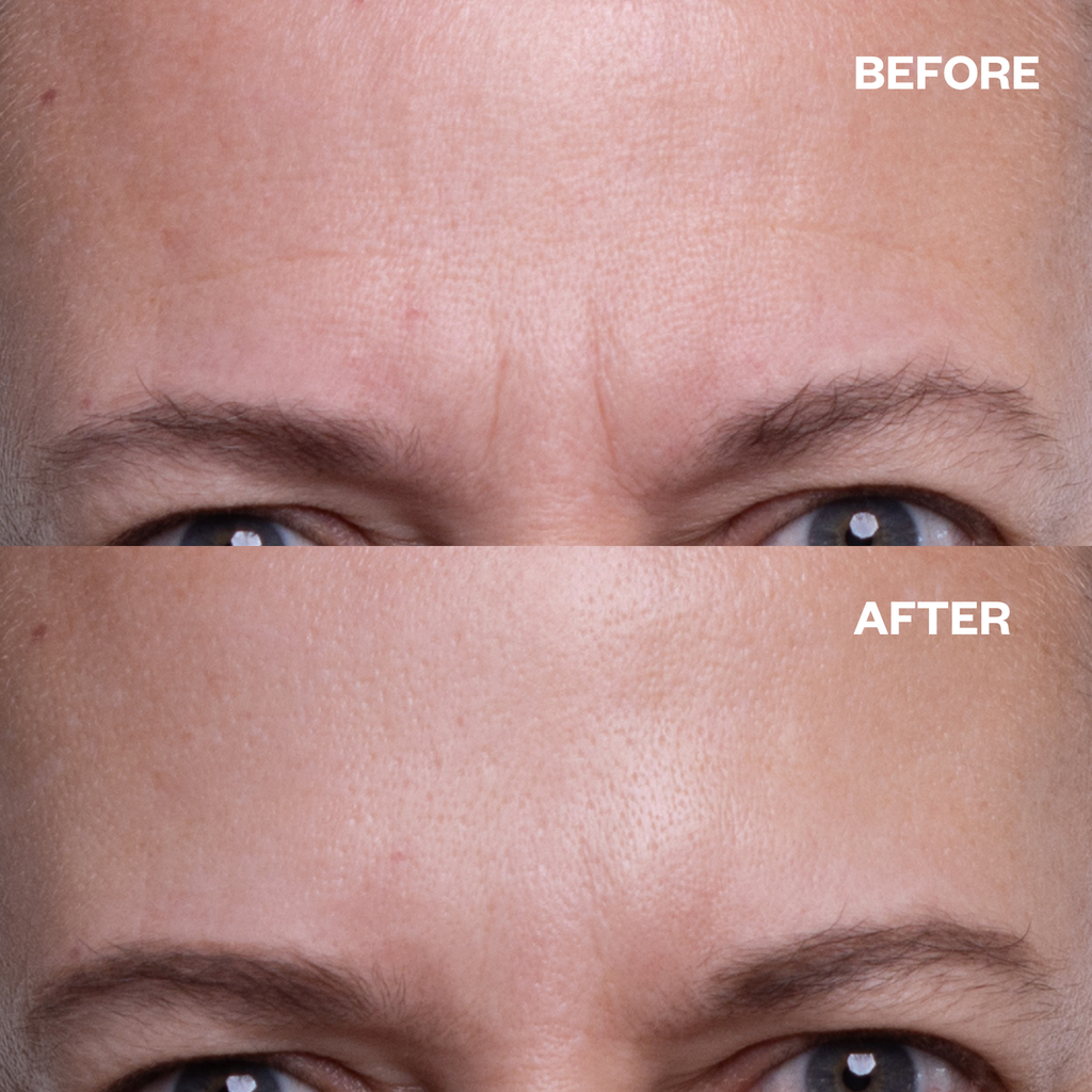 Forehead wrinkles silicone Patches for wrinkles before and after results