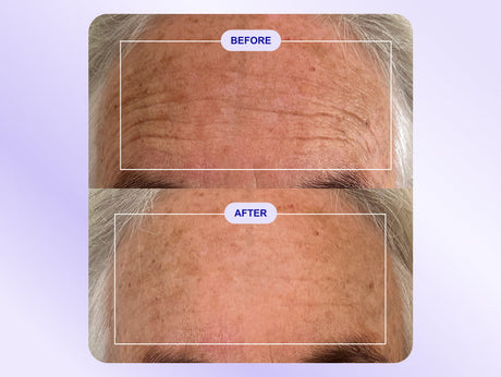 Wrinkles Schminkles blog banner featuring a customer's forehead wrinkle patch results