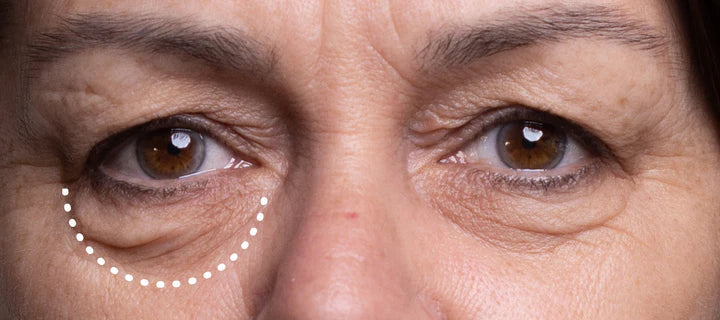 Wrinkles Schminkles blog banner on non-surgical alternatives to eye bag removal surgery