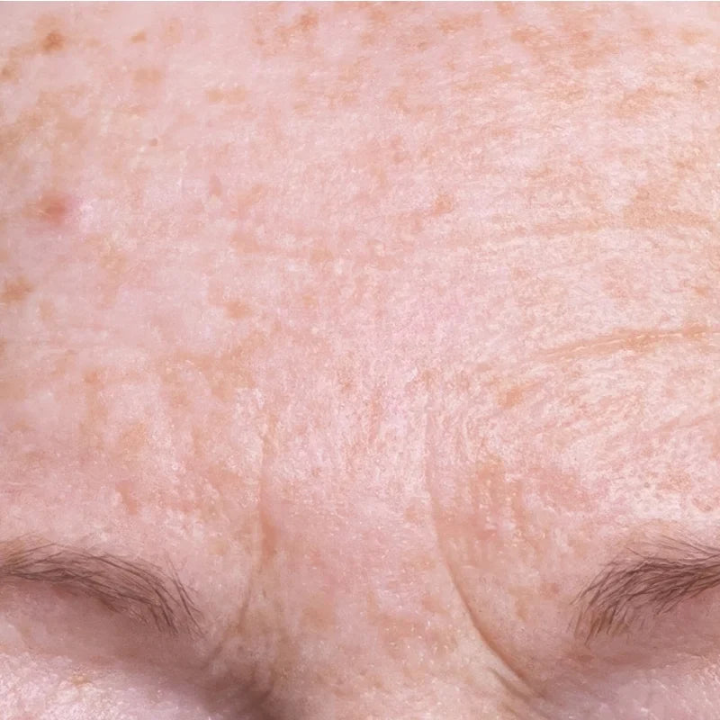 FORHEAD_BEFORE.webp