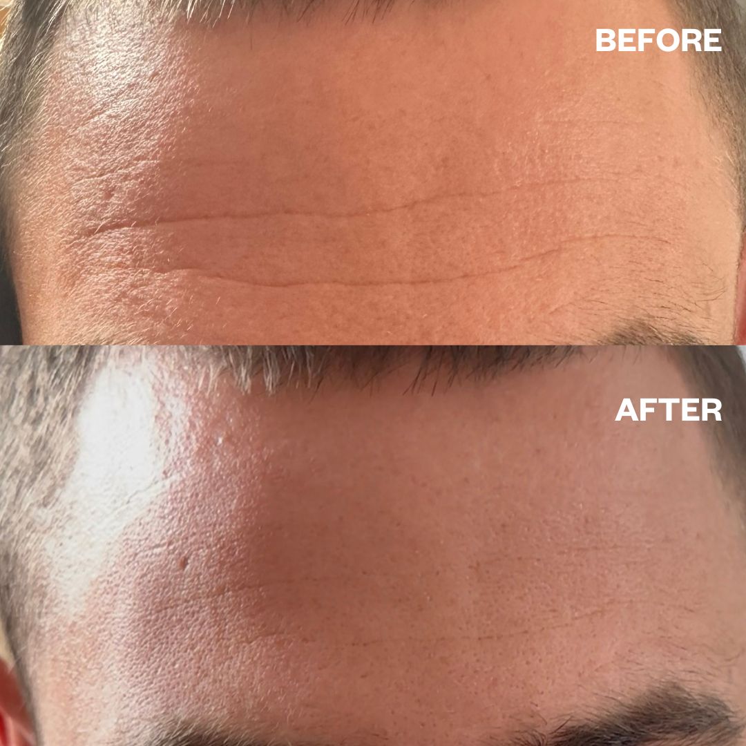 Men's Pro Forehead Wrinkle Patch