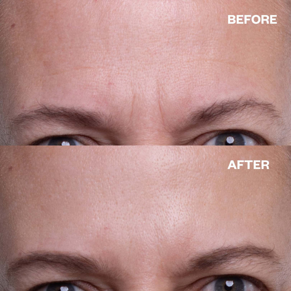 Brow Frown & Bunny Lines Wrinkle Patches