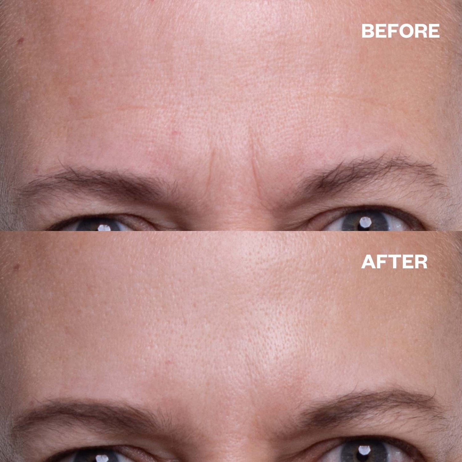 Brow Frown & Bunny Lines Wrinkle Patch | Trial Patch