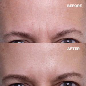 Brow Frown & Bunny Lines Wrinkle Patch | Trial Patch