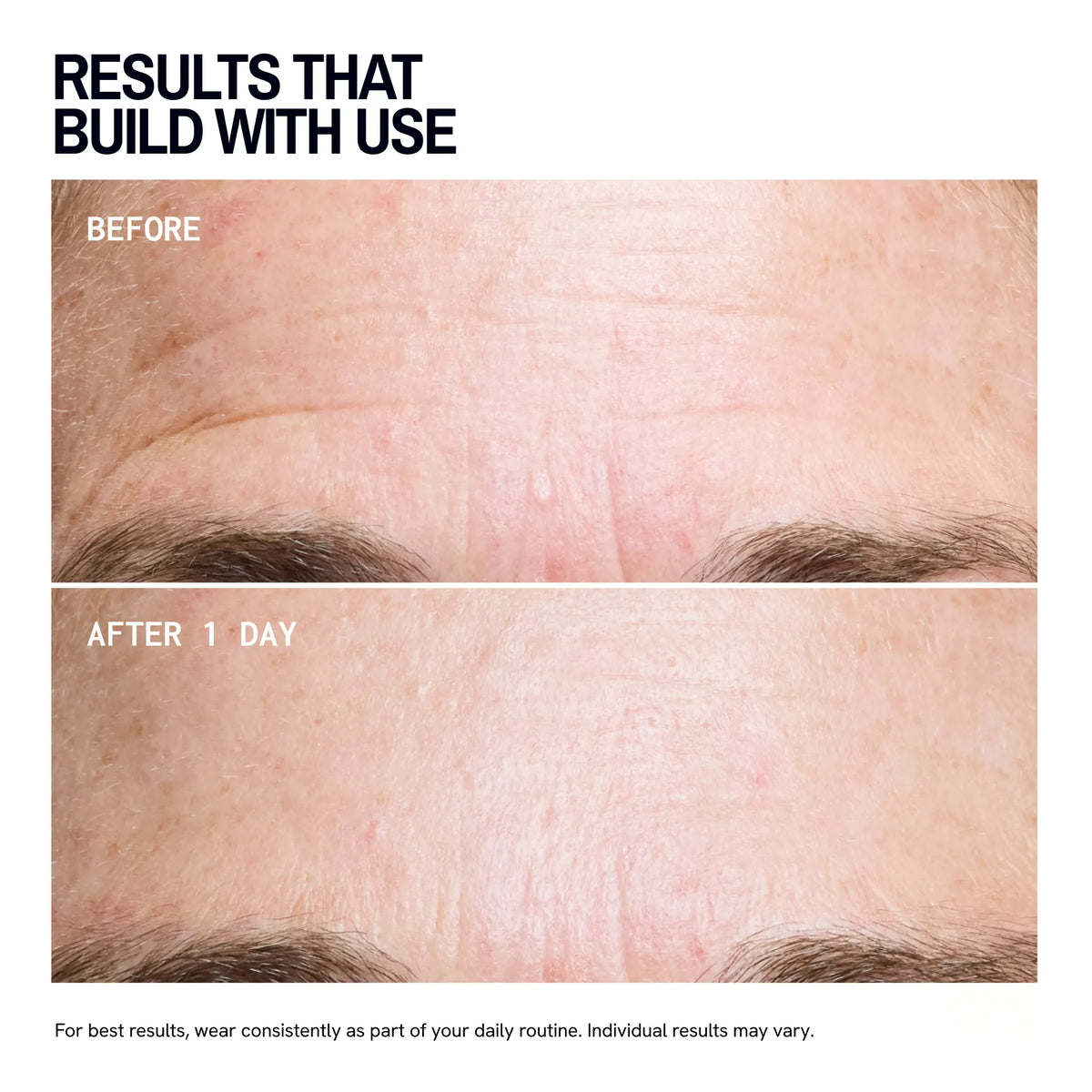Forehead Wrinkle |Trial Patch