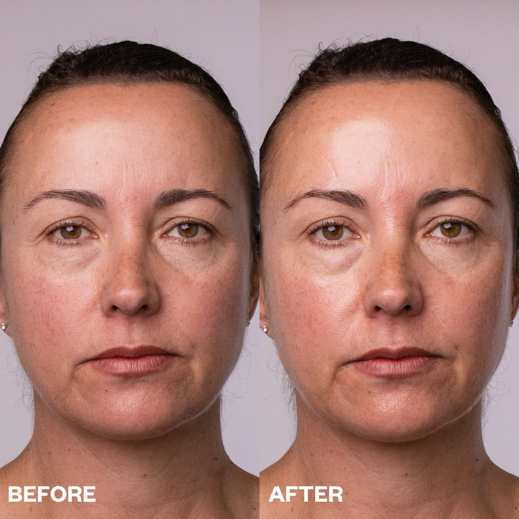 chemical peel face peel pad before and after