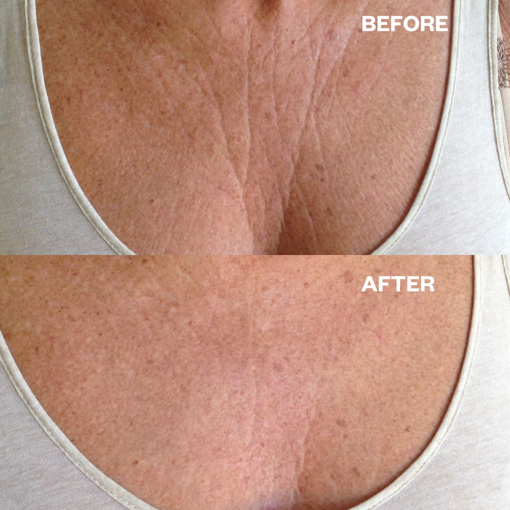 Chest wrinkles chest wrinkle pad before and after results