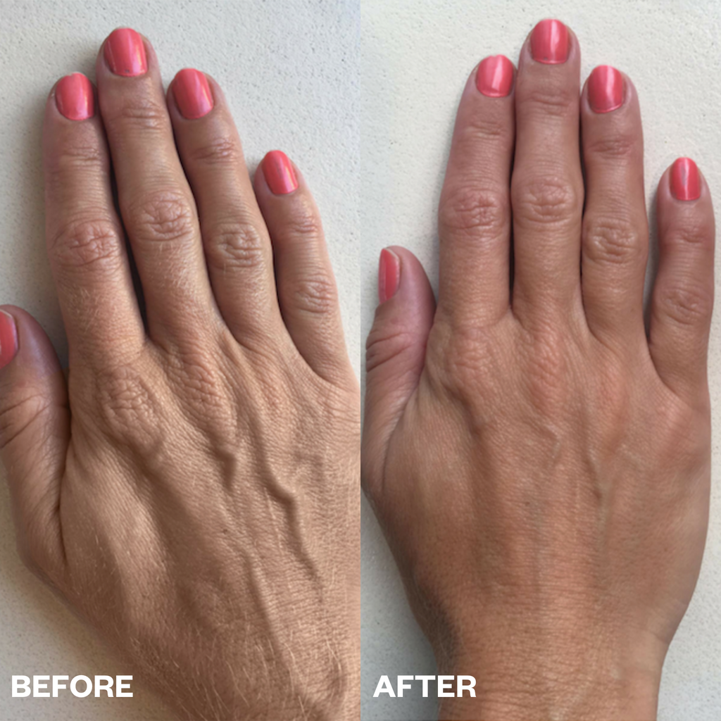 dry hands silicone Patches for wrinkles before and after results