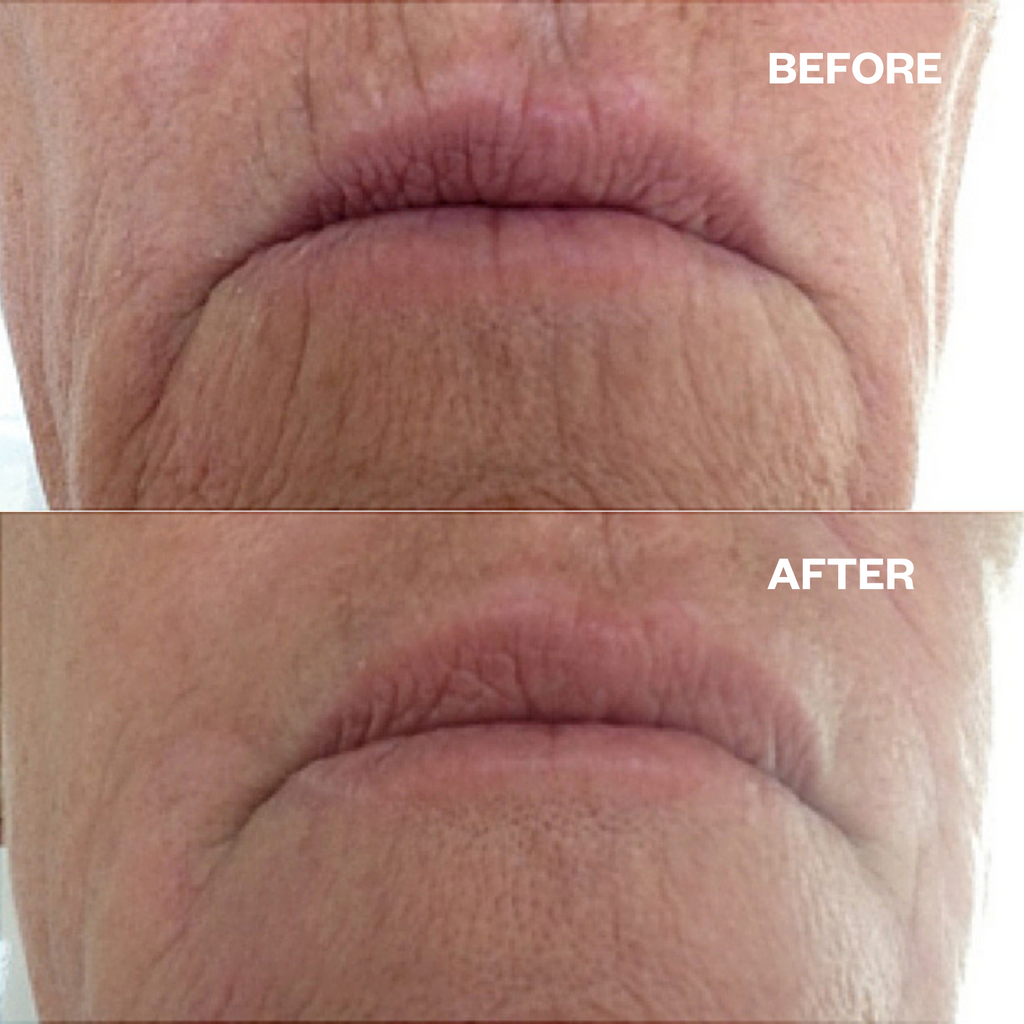 marionette lines lip lines silicone patches for wrinkles before and after results