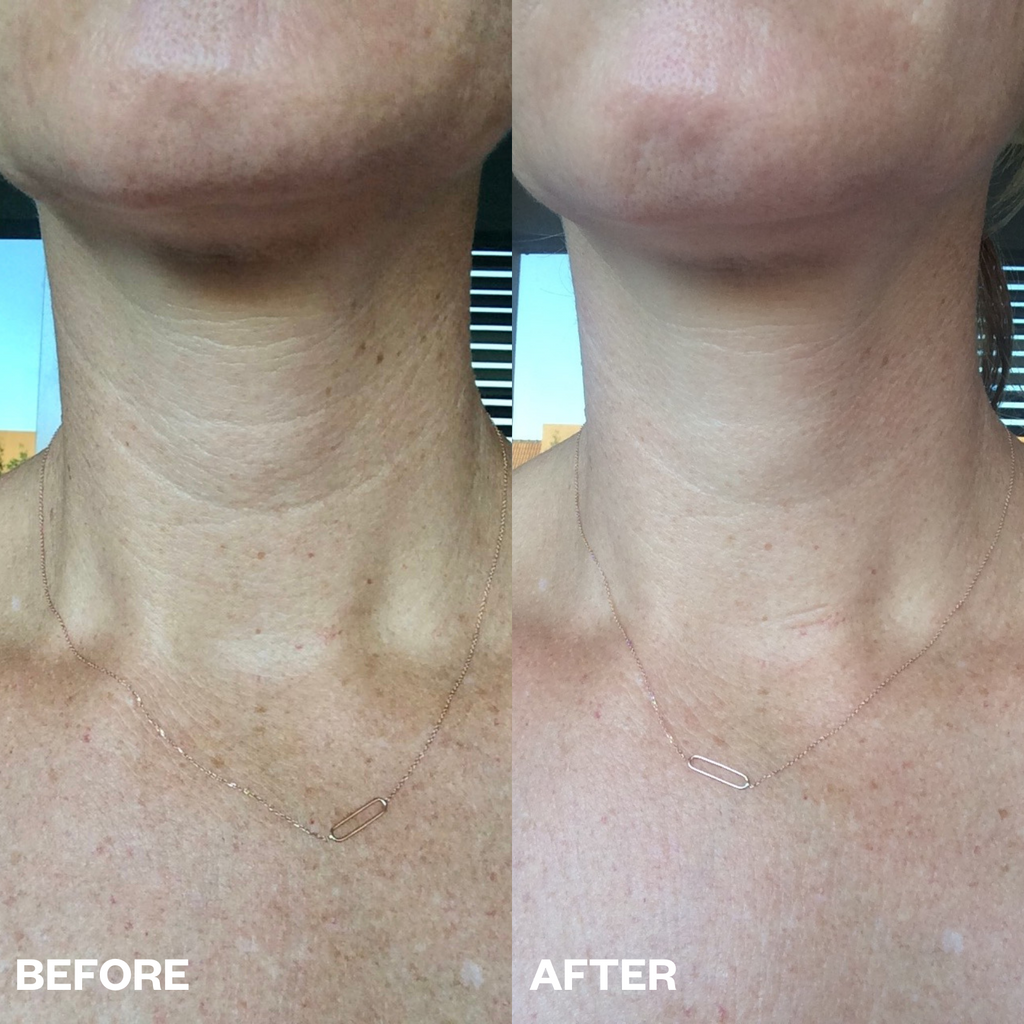 neck Wrinkle Patches before and after results