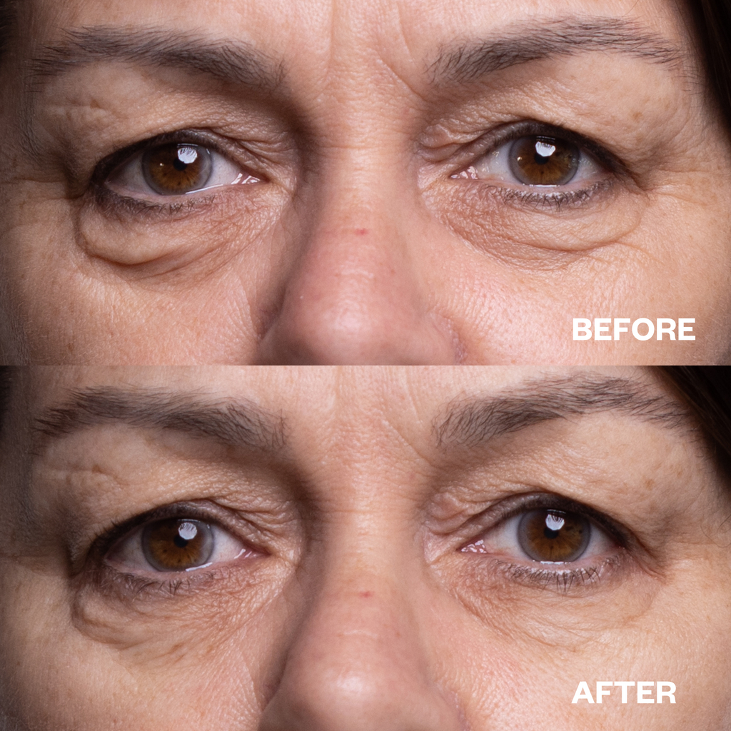 under eye wrinkles silicone eye pads before and after results